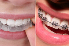 Dental Braces | Teeth Braces Cost, Procedure, Types